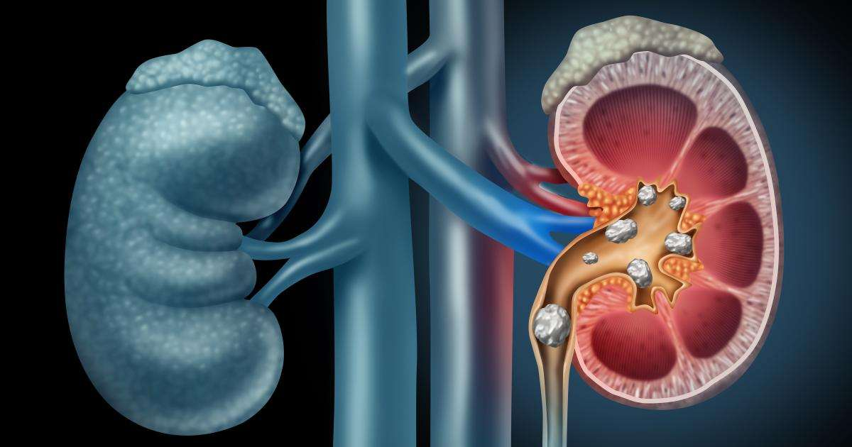 HOMEOPATHIC TREATMENT FOR KIDNEY STONE